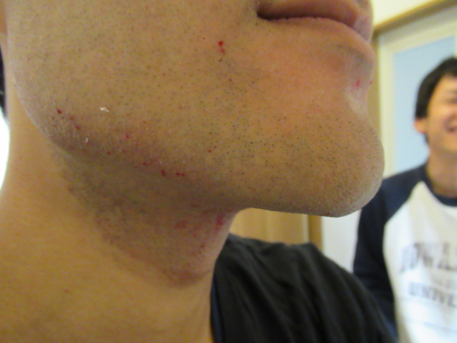 永久脱毛 絶対に知っておきたいヒゲ脱毛５つの真実 10万以上損することも 汗 タカ Taka Brain