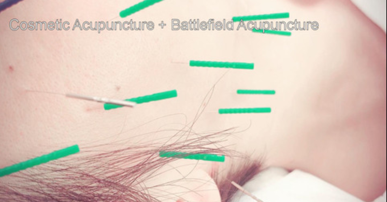 Cosmetic Acupuncture + Battlefield Acupuncture（美顔鍼+バトルフィールド鍼灸）